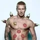 Learning Cupping Therapy Hijama