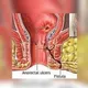 Rawatan Fistula Malaysia