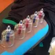 Ottawa Cupping Therapy الحجامة والكاسات الهوائية